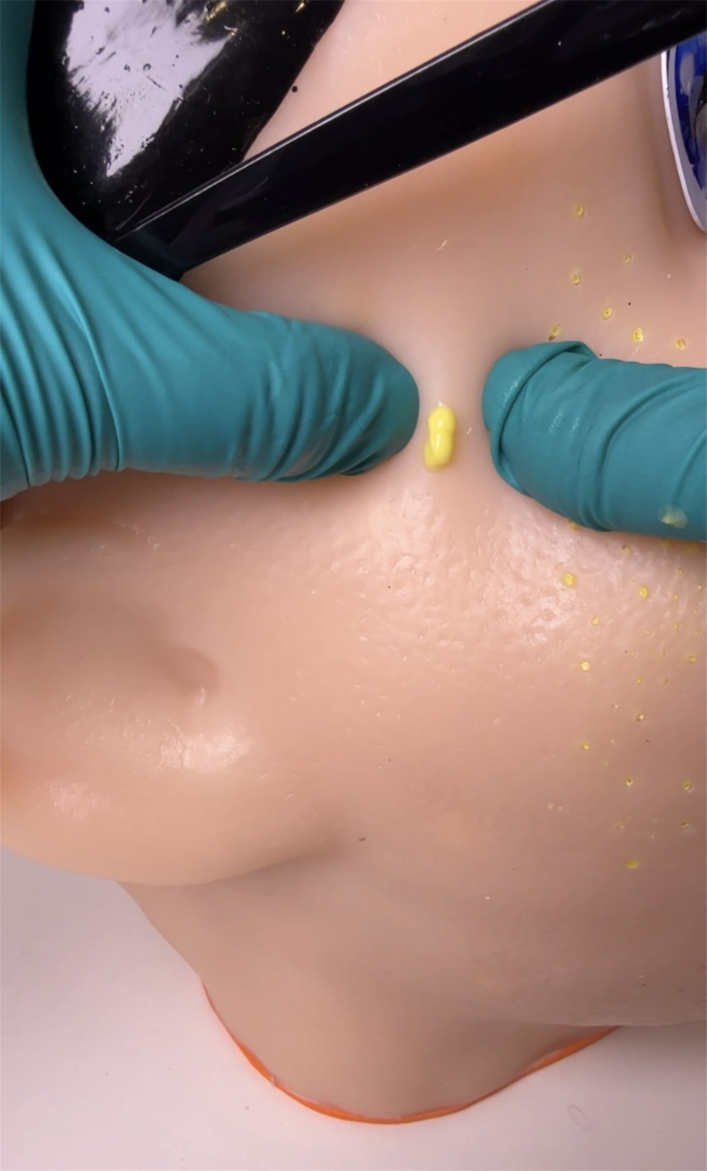 Eco-Friendly Realistic Acne Popping Stress Relief Toy - Big Head Pimple Squeezer For Anxiety Relief