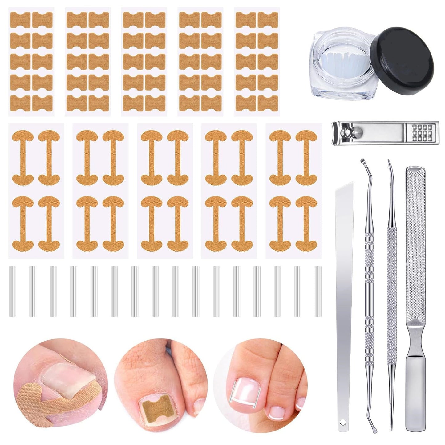 Nail Corrector Set™