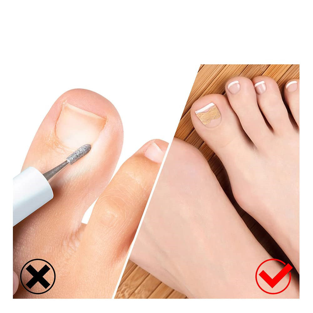 Nail Corrector Set™