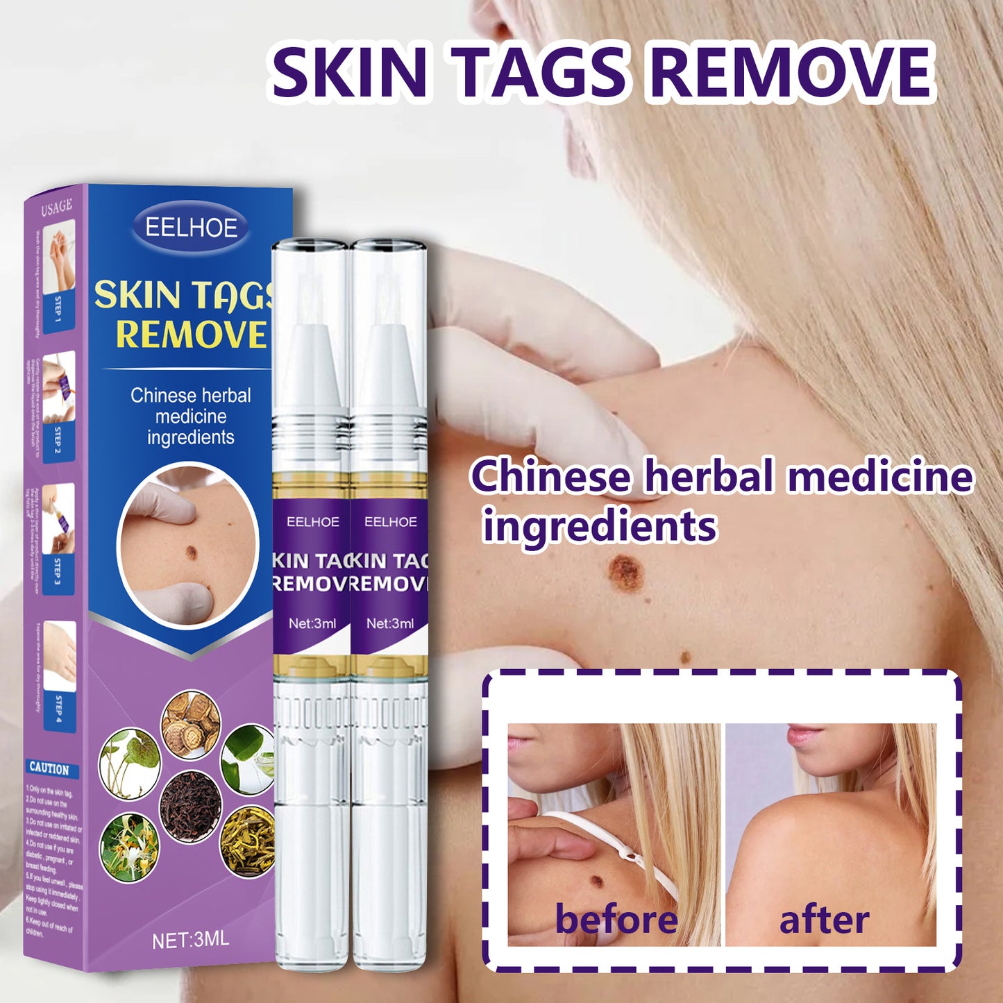 Mole Removal™